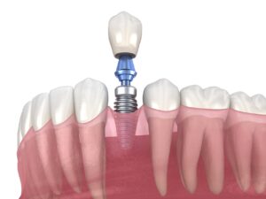 5 Reasons Why Dental Implants Are Worth the Investment.