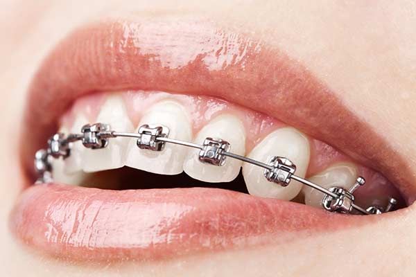 Traditional Braces