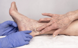 How to Identify Spider Veins: A Guide for Beginners & Advanced Users